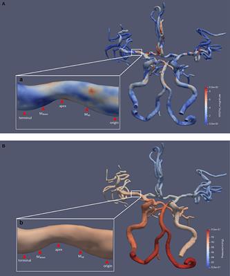 Characteristics of Wall Shear Stress and Pressure of Intracranial Atherosclerosis Analyzed by a Computational Fluid Dynamics Model: A Pilot Study
